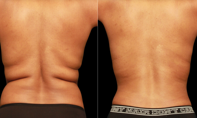 Renuvion® Before and After (Photo Courtesy of J. Kevin Duplechain, MD via Renuvion.com)