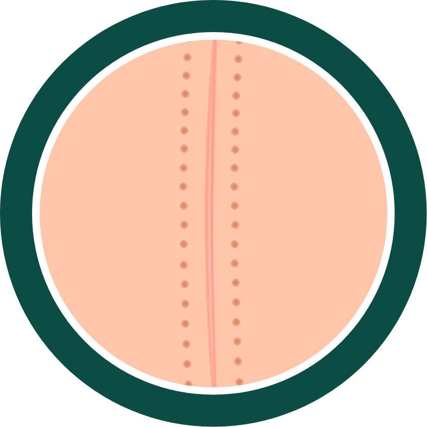 Illustration of a facelift scar during the proliferative phase as the scar begins to fade and flatten.